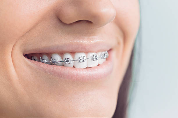 Best Traditional Braces  in Fairbury, IL
